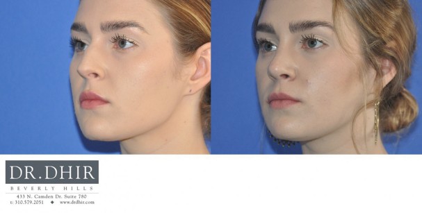 30 year old female with nasal hump, wide nasal bones and unrefined nasal tip underwent open finesse rhinoplasty.  The nasal hump was removed, the septum was straightened and the nasal tip was refined.