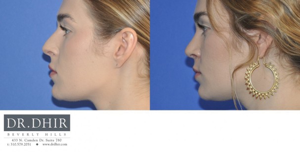 30 year old female with nasal hump, wide nasal bones and unrefined nasal tip underwent open finesse rhinoplasty.  The nasal hump was removed, the septum was straightened and the nasal tip was refined.