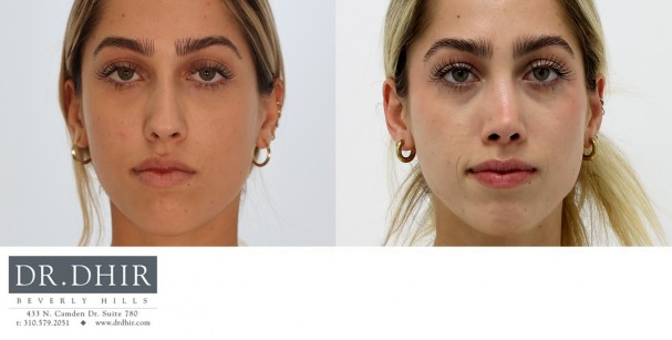 20 year old Middle Eastern Female presents with deviated nasal septum, nasal hump, and asymmetric bulbous nasal tip.  She underwent open rhinoplasty with septal straightening and refinement of nasal tip.