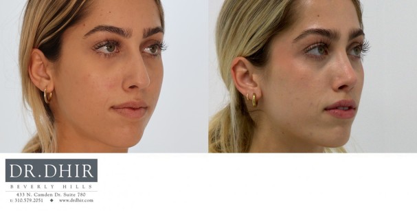 20 year old Middle Eastern Female presents with deviated nasal septum, nasal hump, and asymmetric bulbous nasal tip.  She underwent open rhinoplasty with septal straightening and refinement of nasal tip.