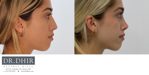 20 year old Middle Eastern Female presents with deviated nasal septum, nasal hump, and asymmetric bulbous nasal tip.  She underwent open rhinoplasty with septal straightening and refinement of nasal tip.