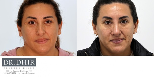 30 year old Hispanic female presents with nasal hump and over projected nasal tip with thick skin.  Open rhinoplasty was performed with nasal hump removal, nasal tip deprojection with refinement and support, deviated septum correct,  and nostril narrowing with alar wedge reduction