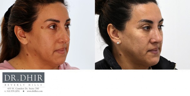30 year old Hispanic female presents with nasal hump and over projected nasal tip with thick skin.  Open rhinoplasty was performed with nasal hump removal, nasal tip deprojection with refinement and support, deviated septum correct,  and nostril narrowing with alar wedge reduction