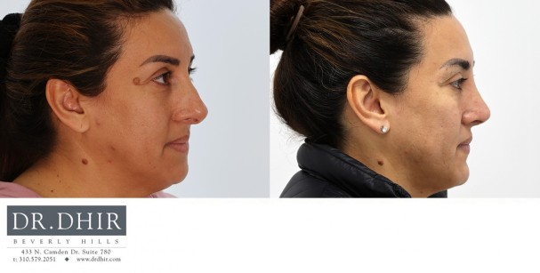 30 year old Hispanic female presents with nasal hump and over projected nasal tip with thick skin.  Open rhinoplasty was performed with nasal hump removal, nasal tip deprojection with refinement and support, deviated septum correct,  and nostril narrowing with alar wedge reduction