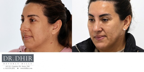 30 year old Hispanic female presents with nasal hump and over projected nasal tip with thick skin.  Open rhinoplasty was performed with nasal hump removal, nasal tip deprojection with refinement and support, deviated septum correct,  and nostril narrowing with alar wedge reduction