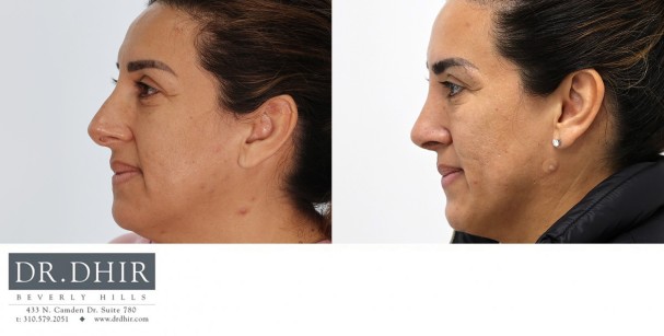30 year old Hispanic female presents with nasal hump and over projected nasal tip with thick skin.  Open rhinoplasty was performed with nasal hump removal, nasal tip deprojection with refinement and support, deviated septum correct,  and nostril narrowing with alar wedge reduction