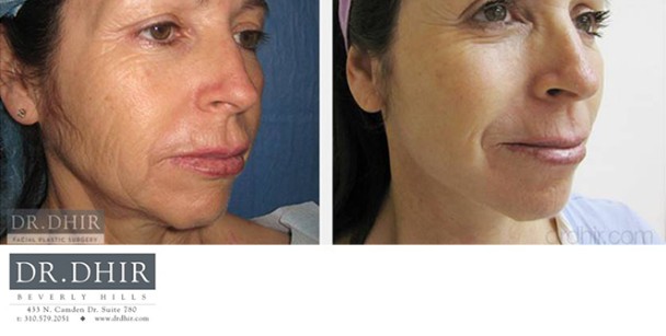 Face-and-Neck-1