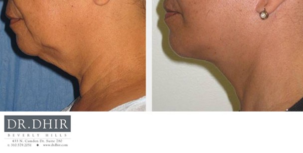 Face-and-Neck-2-1