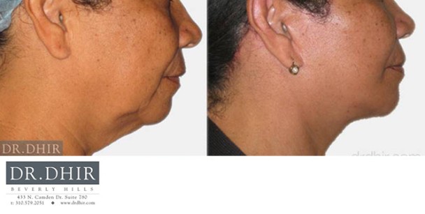 Face-and-Neck-2-2