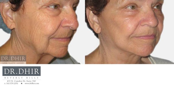 Face-and-Neck-3
