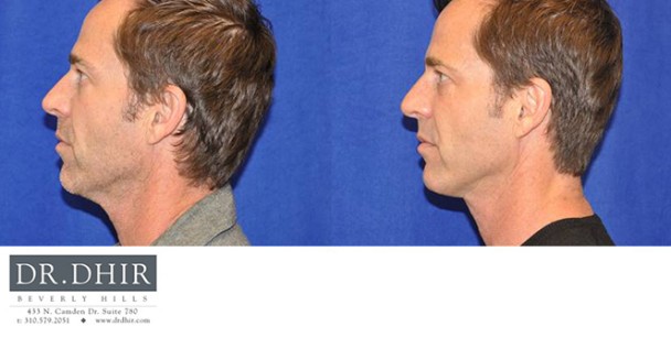 Face-and-Neck-4-1