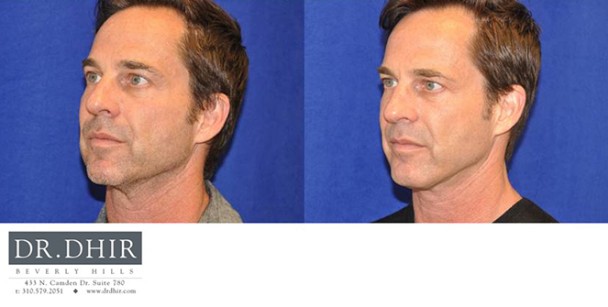 Face-and-Neck-4-2