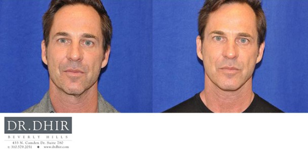 Face-and-Neck-4-3