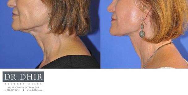 Face-and-Neck-5-2