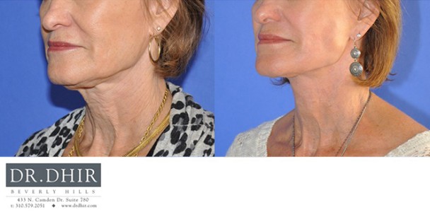 Face-and-Neck-5-3