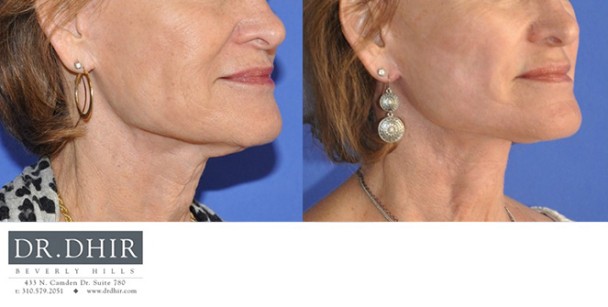 Face-and-Neck-5-4