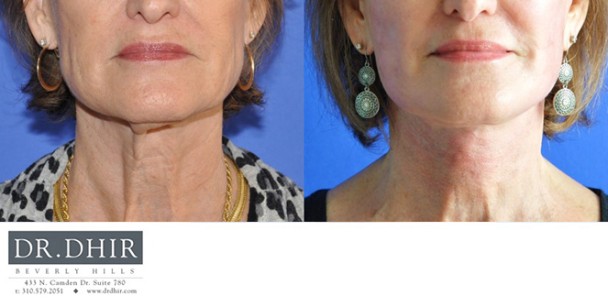 Face-and-Neck-5