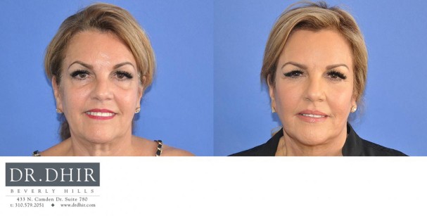 drdhir-face-and-neck-6-1
