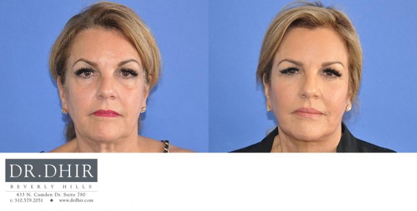 drdhir-face-and-neck-6-2