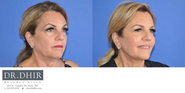 drdhir-face-and-neck-6-3