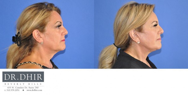 drdhir-face-and-neck-6-4