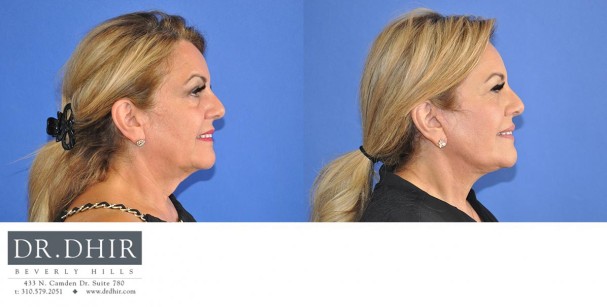 drdhir-face-and-neck-6-5
