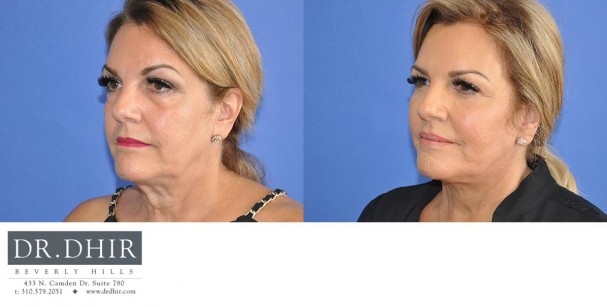 drdhir-face-and-neck-6-6