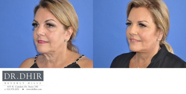 drdhir-face-and-neck-6-7