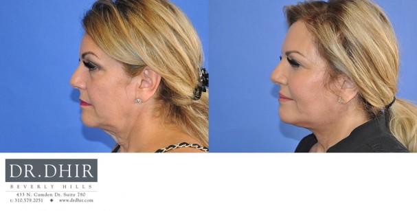 drdhir-face-and-neck-6-8