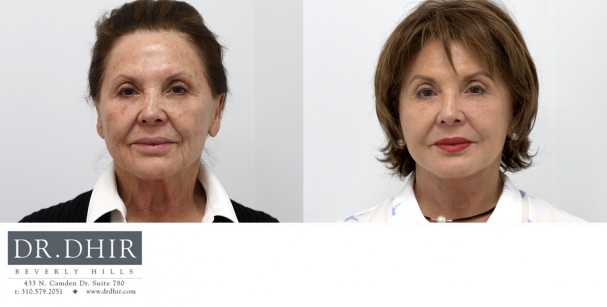 82 year old F underwent deep plane face and neck lift to improve neck contour and suspend the soft tissue of the face in a more youthful position.