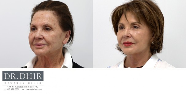 82 year old F underwent deep plane face and neck lift to improve neck contour and suspend the soft tissue of the face in a more youthful position.