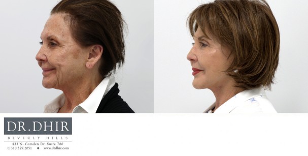 82 year old F underwent deep plane face and neck lift to improve neck contour and suspend the soft tissue of the face in a more youthful position.