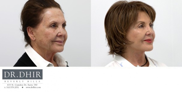 82 year old F underwent deep plane face and neck lift to improve neck contour and suspend the soft tissue of the face in a more youthful position.