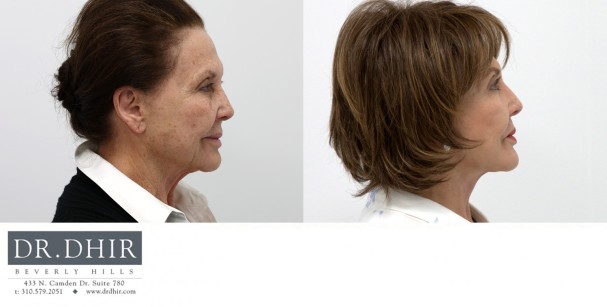 82 year old F underwent deep plane face and neck lift to improve neck contour and suspend the soft tissue of the face in a more youthful position.
