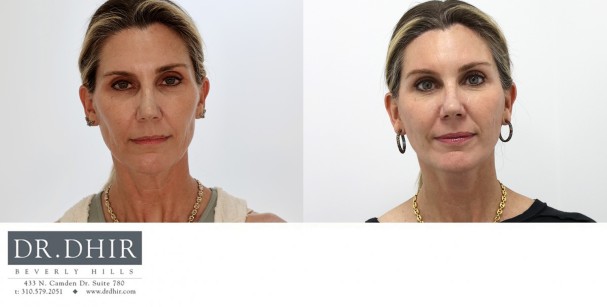 50 year old Female was concerned about her neck skin laxity.  A lower face and neck lift was performed with all incisions hidden along the ear and hair line.