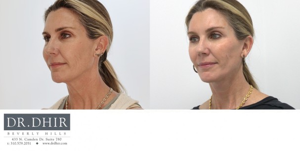 50 year old Female was concerned about her neck skin laxity.  A lower face and neck lift was performed with all incisions hidden along the ear and hair line.