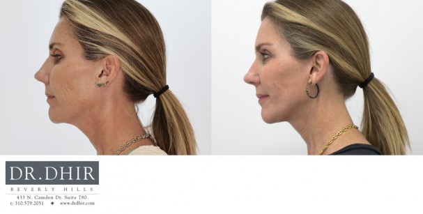 50 year old Female was concerned about her neck skin laxity.  A lower face and neck lift was performed with all incisions hidden along the ear and hair line.