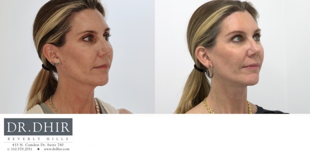 50 year old Female was concerned about her neck skin laxity.  A lower face and neck lift was performed with all incisions hidden along the ear and hair line.