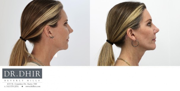 50 year old Female was concerned about her neck skin laxity.  A lower face and neck lift was performed with all incisions hidden along the ear and hair line.