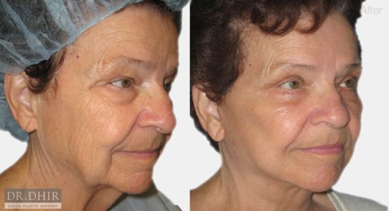 facelift