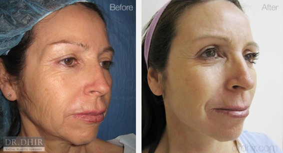 facelift1