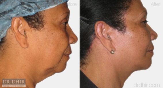 facelift2