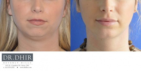 drdhir-facial-implant-5-1