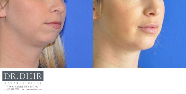 drdhir-facial-implant-5-2