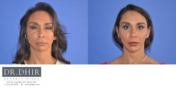 drdhir-facial-implant-6-1