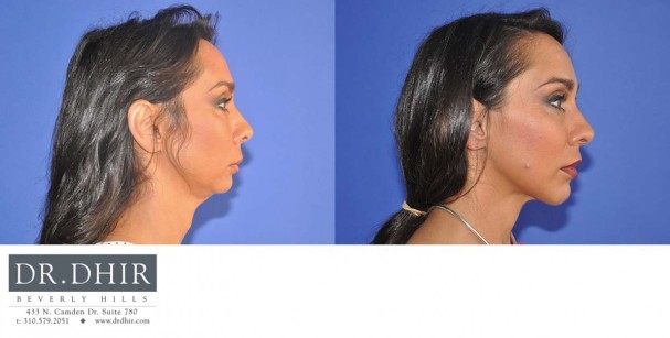 drdhir-facial-implant-6-3