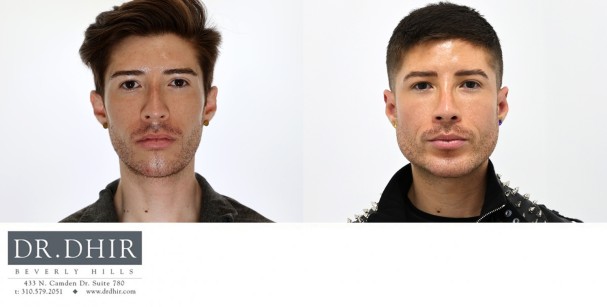 33 year old Hispanic Male underwent custom jaw/mandible implant to improve an underdeveloped chin, jaw angle with a 3d customized jaw line contour.  In addition, he underwent a rhinoplasty and buccal fat removal.