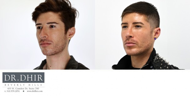 33 year old Hispanic Male underwent custom jaw/mandible implant to improve an underdeveloped chin, jaw angle with a 3d customized jaw line contour.  In addition, he underwent a rhinoplasty and buccal fat removal.