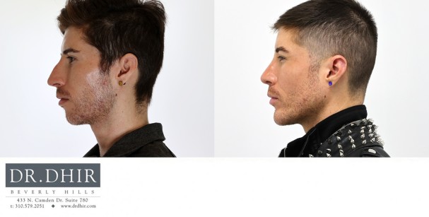 33 year old Hispanic Male underwent custom jaw/mandible implant to improve an underdeveloped chin, jaw angle with a 3d customized jaw line contour.  In addition, he underwent a rhinoplasty and buccal fat removal.