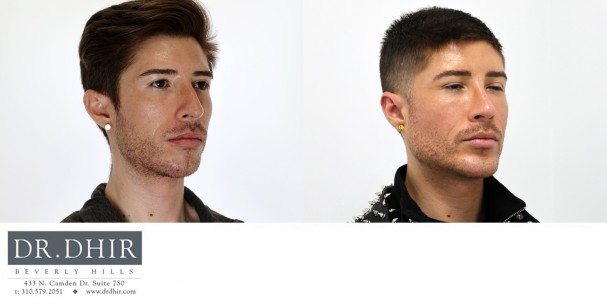 33 year old Hispanic Male underwent custom jaw/mandible implant to improve an underdeveloped chin, jaw angle with a 3d customized jaw line contour.  In addition, he underwent a rhinoplasty and buccal fat removal.